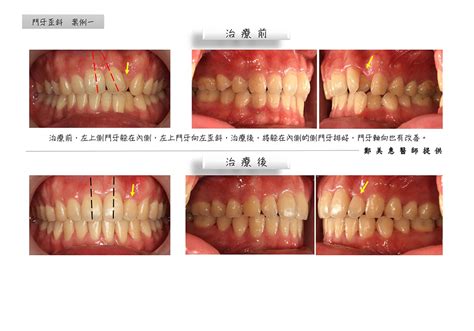 牙齒歪斜|牙齒歪斜問題？